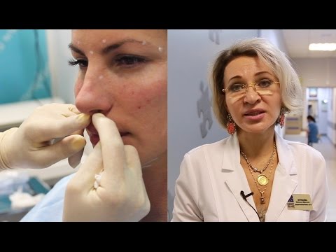 Безопераційна ринопластика: як проводять філерами, нитками, дипроспаном, результат до і після, як роблять з препаратами кінчик носа