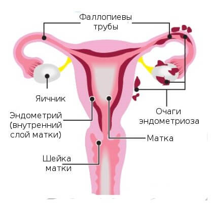 Болі при ендометріозі в області тіла матки: що робити, лікування