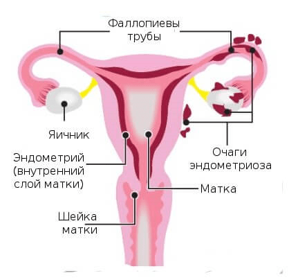 Болі при ендометріозі в області тіла матки: що робити, лікування