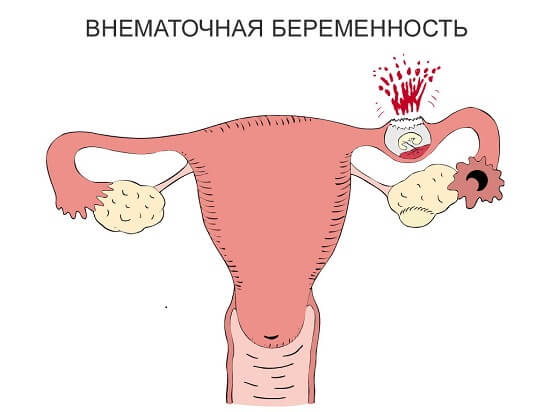 Болі в сечовому міхурі у жінок причини симптоми і лікування