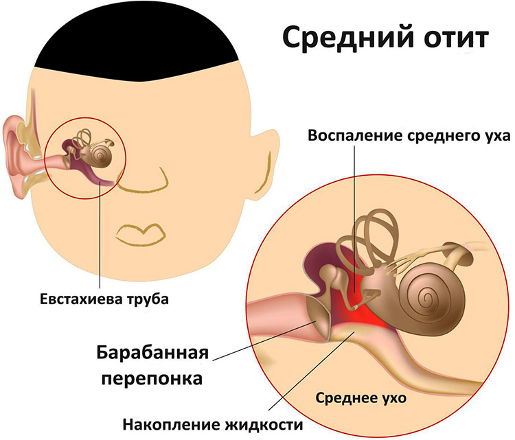 Болить вухо і горло з одного боку: причини і лікування гомеопатією