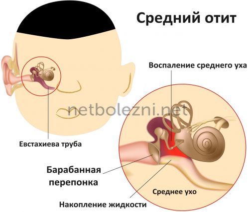 Болить вухо – що робити в домашніх умовах? Вушні краплі при болю у вусі