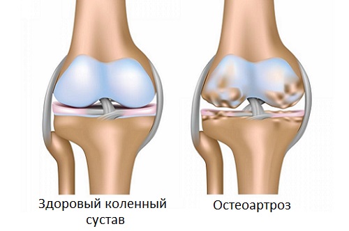 Болять суглоби при клімаксі це норма чи пора звернутися до лікаря