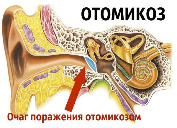 Борна кислота при отиті і болі у вусі