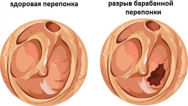 Борна кислота при отиті і болі у вусі