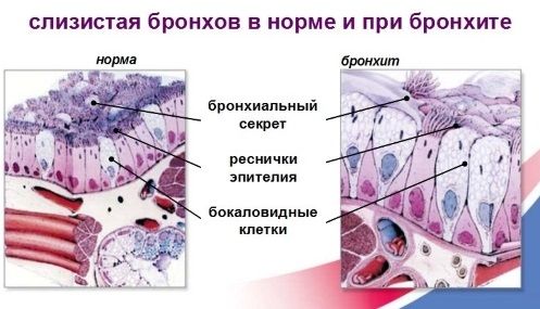 Бронхіт без кашлю чим небезпечний і як лікувати
