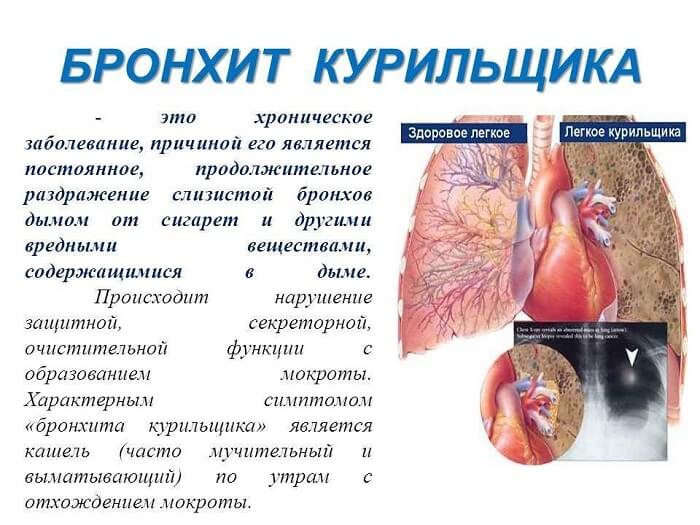 Бронхіт курця причини симптоми і лікування