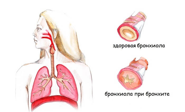 Бронхіт курця причини симптоми і лікування