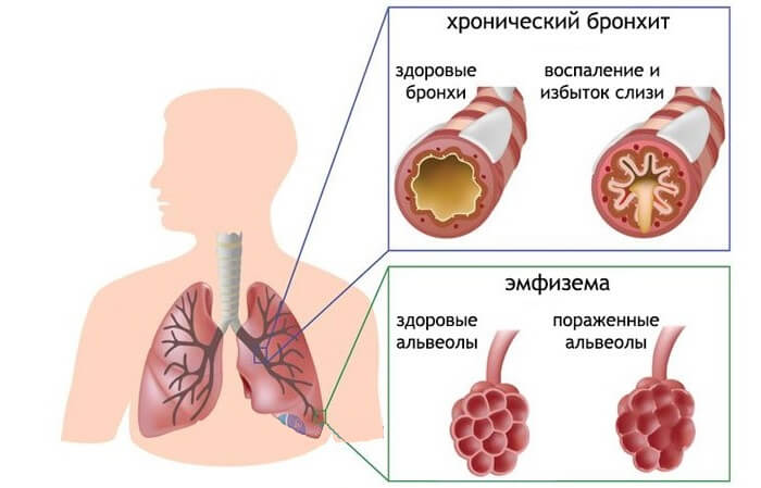 Бронхіт курця причини симптоми і лікування