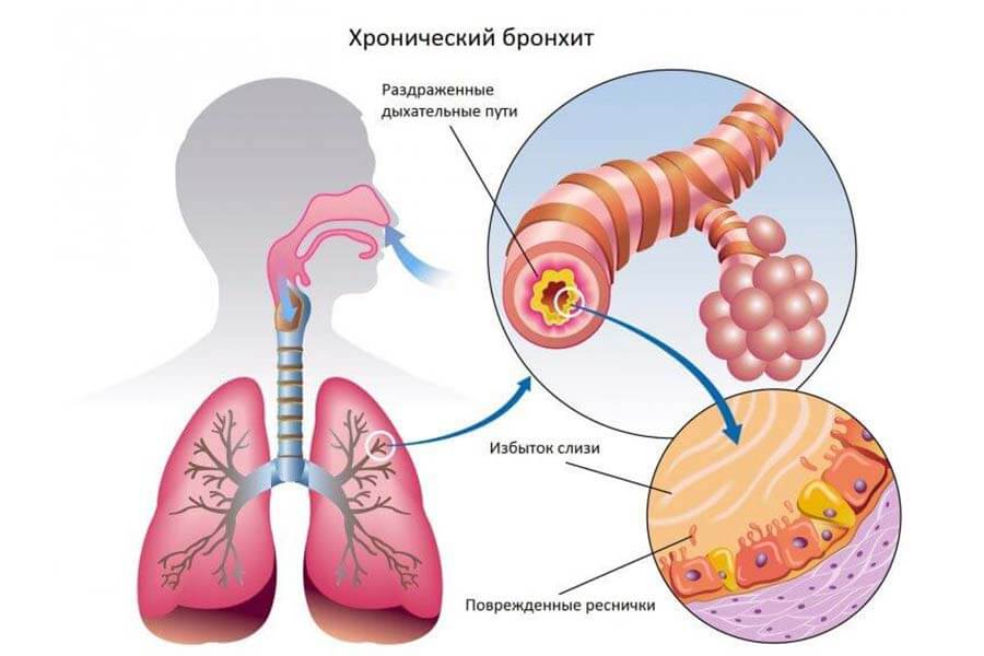 Бронхіт у дітей – причини, симптоми, методи лікування