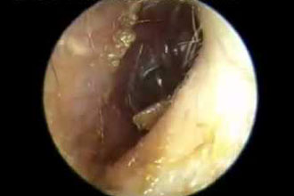 Бульозний або вірусний отит про що говорить такий діагноз і як його уникнути Бульозний або вірусний отит про що говорить такий діагноз і як його уникнути