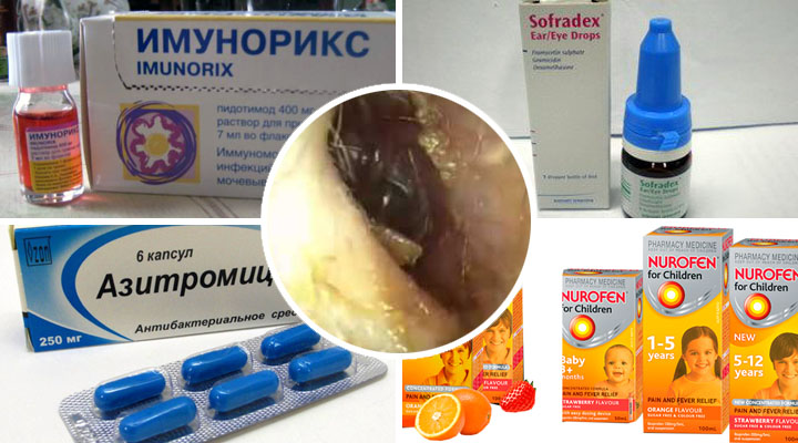 Бульозний або вірусний отит про що говорить такий діагноз і як його уникнути Бульозний або вірусний отит про що говорить такий діагноз і як його уникнути