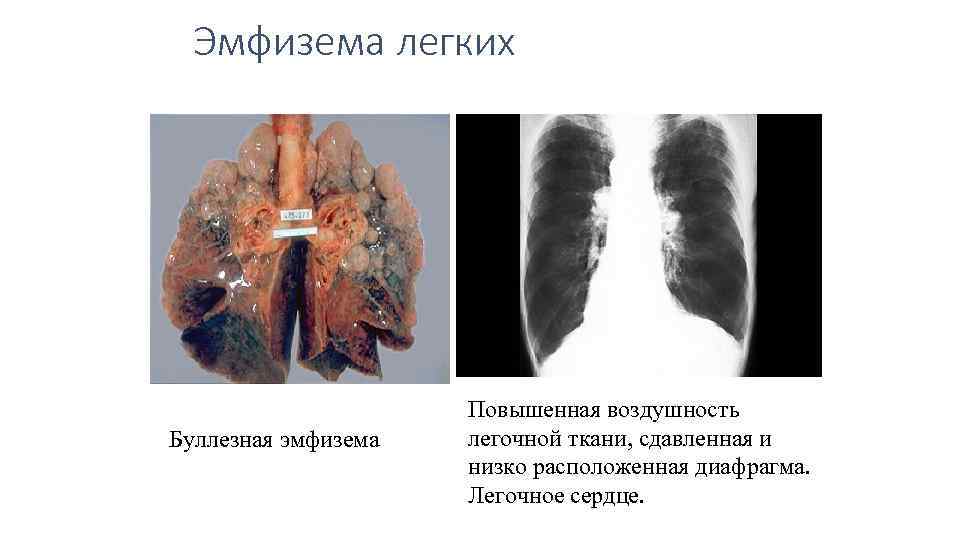 Булли в легенях чому вони з’являються і як їх лікувати