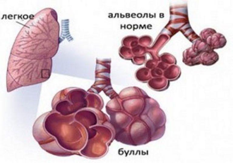 Булли в легенях чому вони з’являються і як їх лікувати
