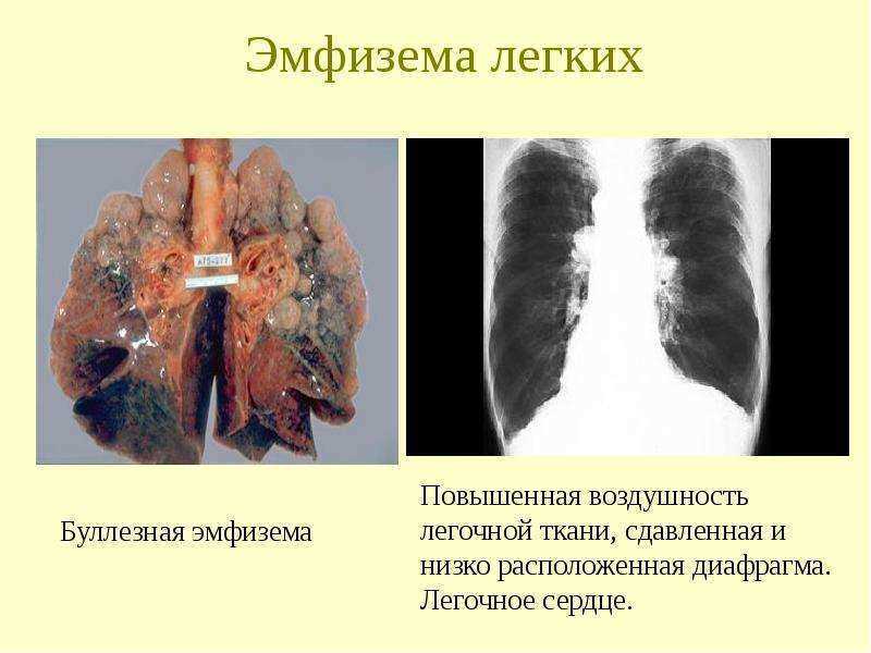 Булли в легенях чому вони з’являються і як їх лікувати