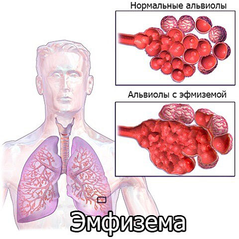 Булли в легенях чому вони з’являються і як їх лікувати