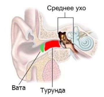 Буллзный отит причини розвитку хвороби і способи лікування