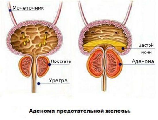 Часте сечовипускання безболісне у чоловіків. Часте сечовипускання безболісне у чоловіка – потрібно переживати