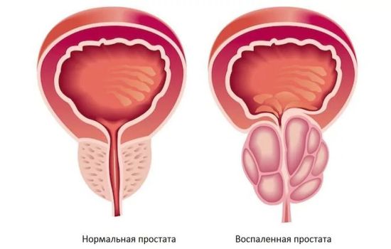 Часте сечовипускання у чоловіків без болю причини і лікування