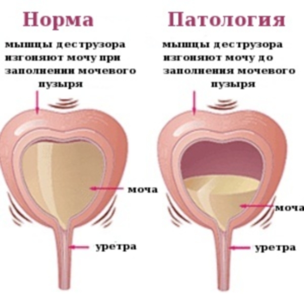Часте сечовипускання у дітей без болю Часте сечовипускання у дітей без болю