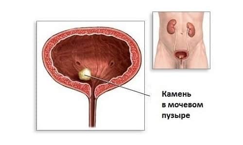 Часте сечовипускання вночі у жінок причини — Нирки