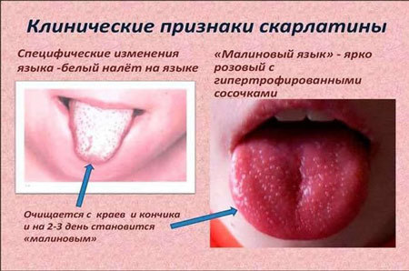 Червона висипка в горлі у дитини: причини і лікування