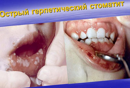 Червона висипка в горлі у дитини: причини і лікування