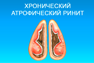 Чи можна при нежиті гріти ніс