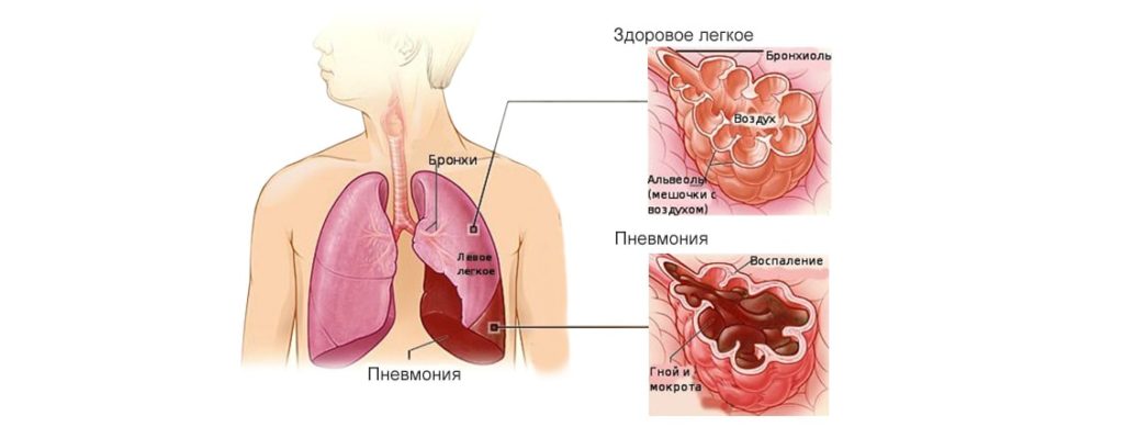 Чи можна при пневмонії – перша допомога після запалення легенів