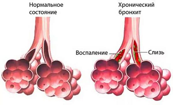 Чи можна вилікувати хронічний бронхіт назавжди в домашніх умовах