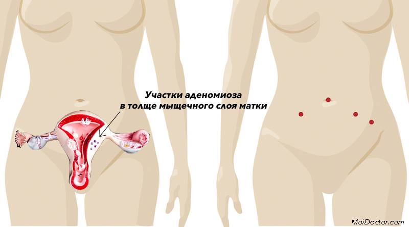 Чи можна засмагати при ендометріозі матки — Мій гінеколог
