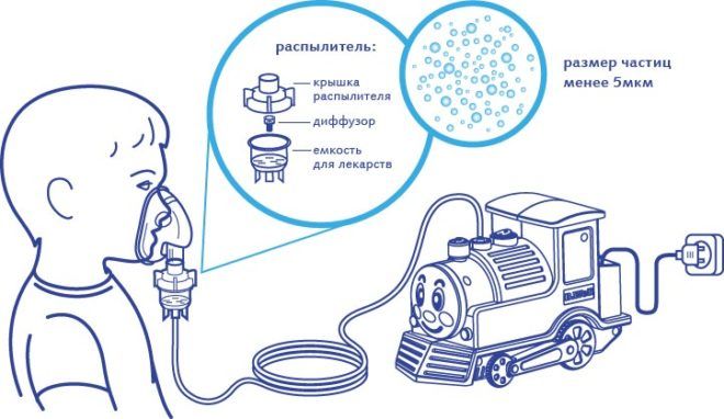 Чим дихати при інгаляції з використанням небулайзера при лікуванні кашлю