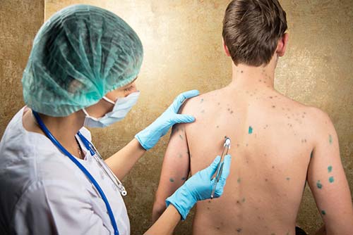 Чим мазати прищі при вітряній віспі у дорослих