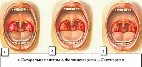 Чим небезпечна гнійна ангіна – наслідки і ускладнення
