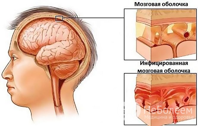 Чим небезпечний гайморит: наслідки та ускладнення