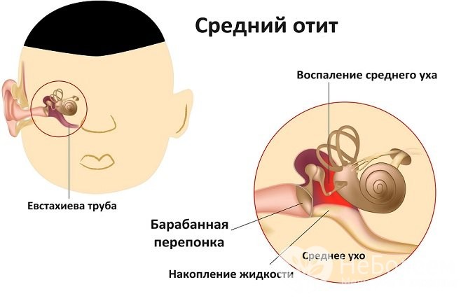 Чим небезпечний гайморит: наслідки та ускладнення