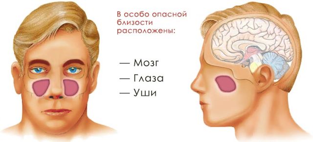 Чим небезпечний недолікований гайморит в запущеній формі симптоми і як лікувати