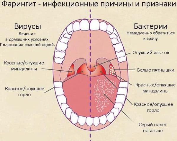 Чим небезпечний тонзиліт під час вагітності причини симптоми і методи лікування
