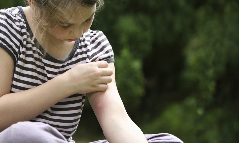 Чим обробляти укуси комарів і мошок?