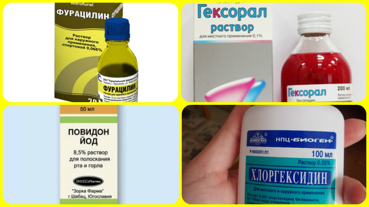 Чим полоскати горло при фарингіті? Чим полоскати горло при фарингіті: особливості полоскання і список ліків при різних видах фарингіту
