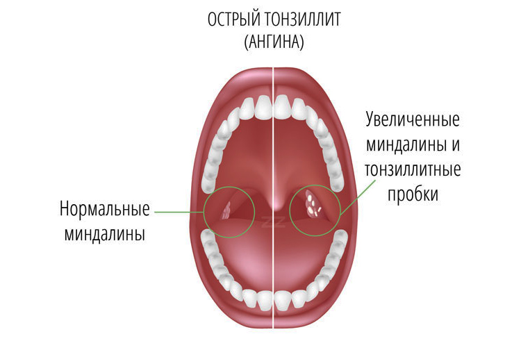 Чим полоскати горло при гнійній ангіні медикаментозні препарати і домашні засоби