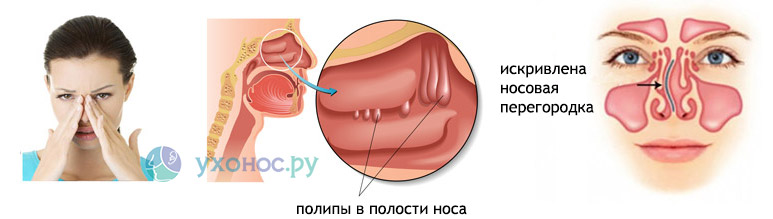 Чим промивати ніс при нежиті