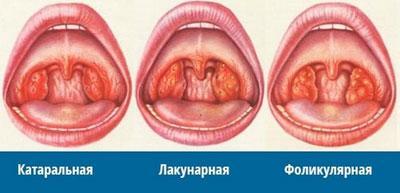 Чим відрізняється ангіна від грипу? Чим відрізняється ангіна від грві – характерні ознаки.