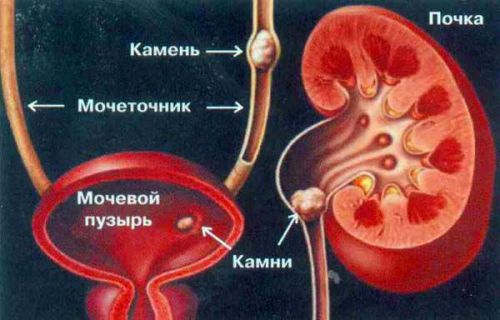 Чим відрізняється неспецифічний негонококковый уретрит від звичайного і як його лікувати
