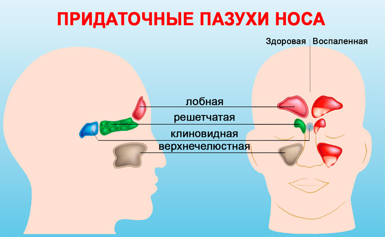Чим відрізняється риніт від синуситу