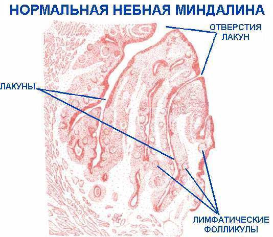 Чим викликані гнійні пробки в горлі і як їх лікувати
