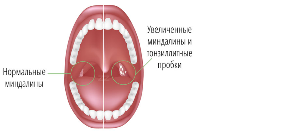 Чим викликані гнійні пробки в горлі і як їх лікувати