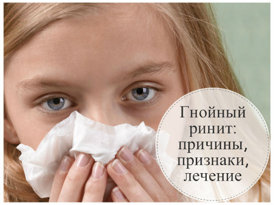 Чим і як лікувати гнійний нежить