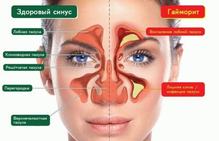 Чому болить голова при гаймориті