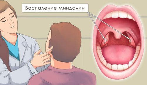 Чому болить носоглотка і як лікувати цей симптом